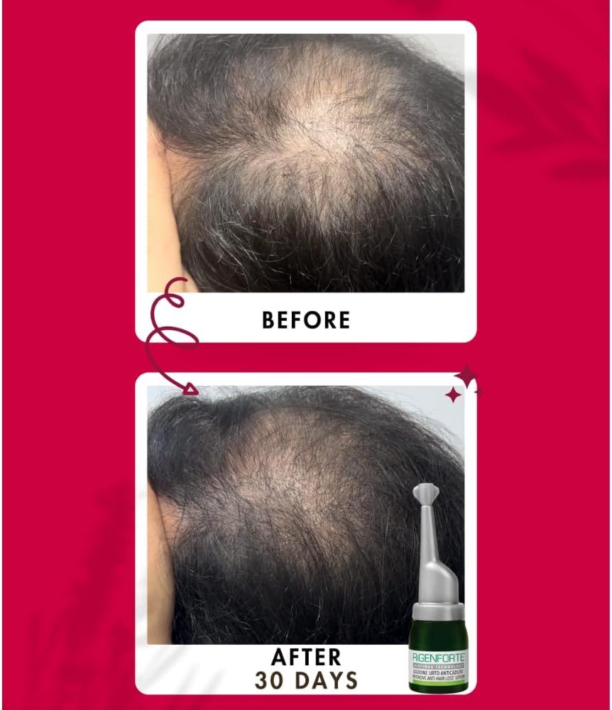 Rigenforte Anti-Hair Loss Lotion 12 Vials with Scalp Massager Brush Rigenforte